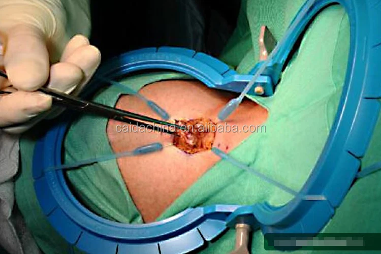 Table Mounted Retractors disposable Vaginal Retractor Set Simpson Expandable Ring