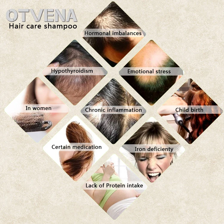 OTVENA hair lost products best private label bottle anti dandruff hair loss shampoo