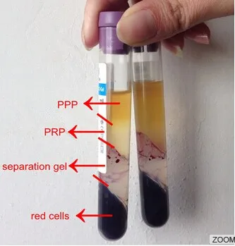 ACD sodium citrate gel Platelet rich plasma PRP tube