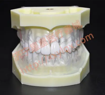 Peroidontal disease dental model with transparent clear gum demostrates ginivae recession
