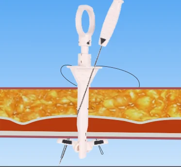 Manufacturer Surgical Disposable Endo Fascial Closure Device