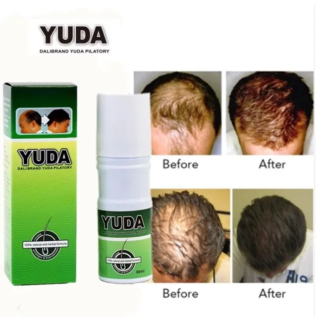 Chinese Trending Hair Care Product YUDA Effective Hair Loss Treatment For Hair Growth
