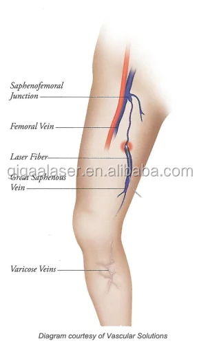 Диодный лазер 15 Вт 1470 нм для эндовенной обработки