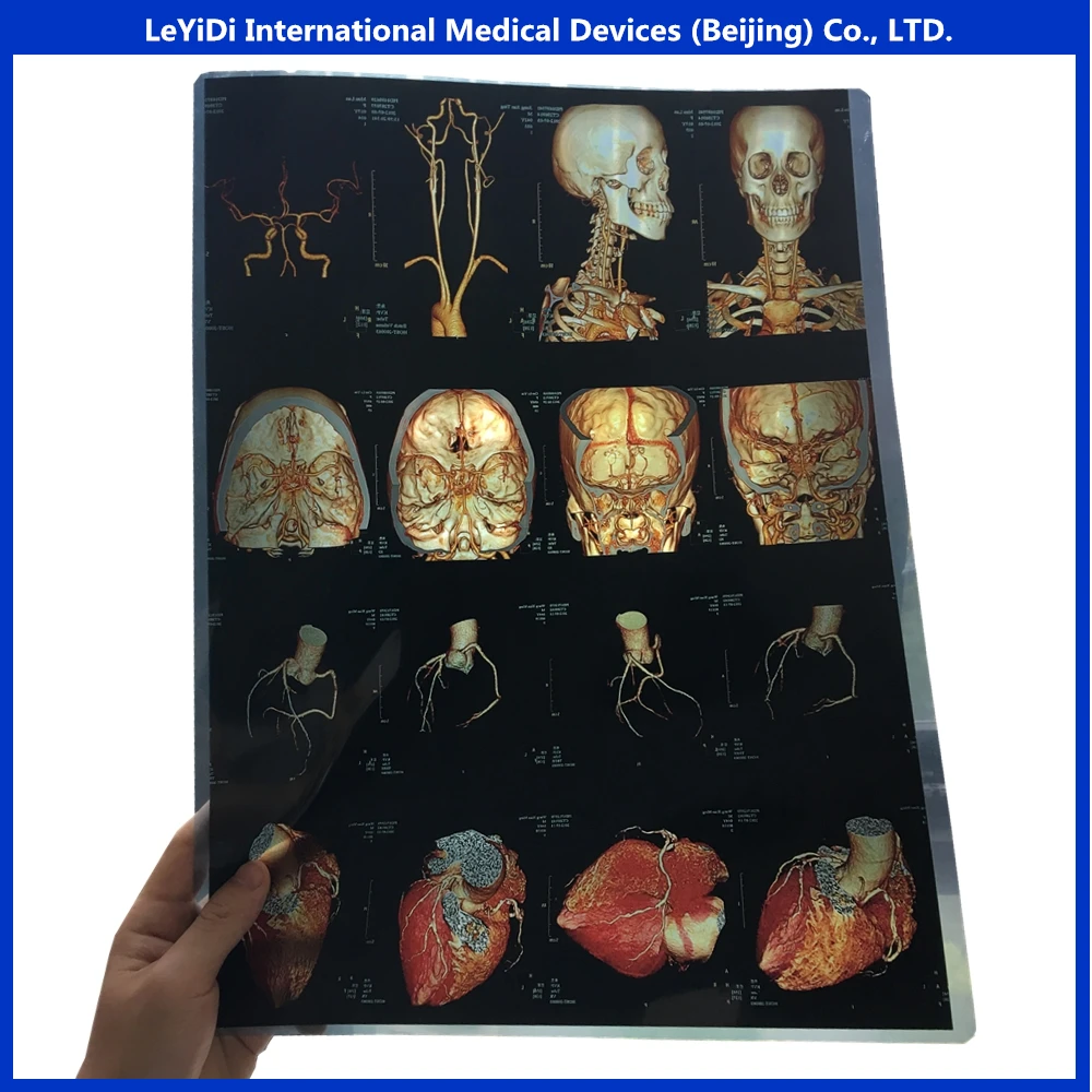 
Low price blue color inkjet medical printing PET film for MRI and CT 