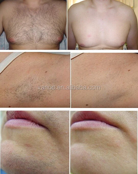 
painfree Soprano Alma Laser 