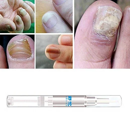Nail Treatment Pen 4pcs Infection Bright Pencil Fungal Treatment Anti Fungus Biological Repair 3ml Restores Healthy Nails