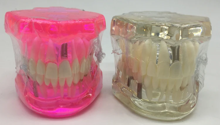 Tooth Restoration model with Implant