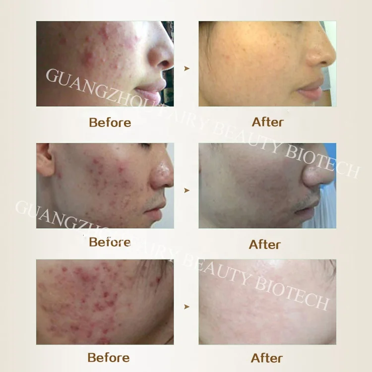 Safe effective herbal cosmetics pimples acne removal cream