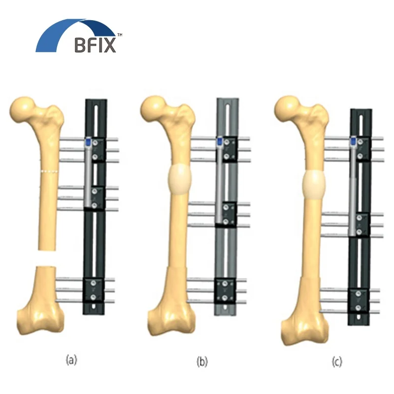 Large distal defect in the femur LRS Fixator in place Proximal metaphyseal osteotomy