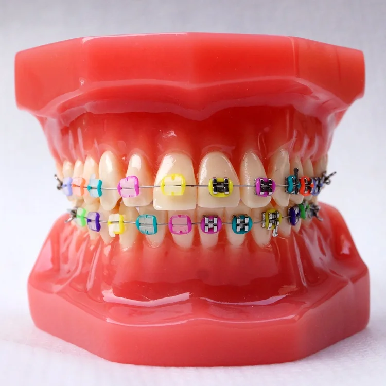 Dental Orthodontic model With metal bracket