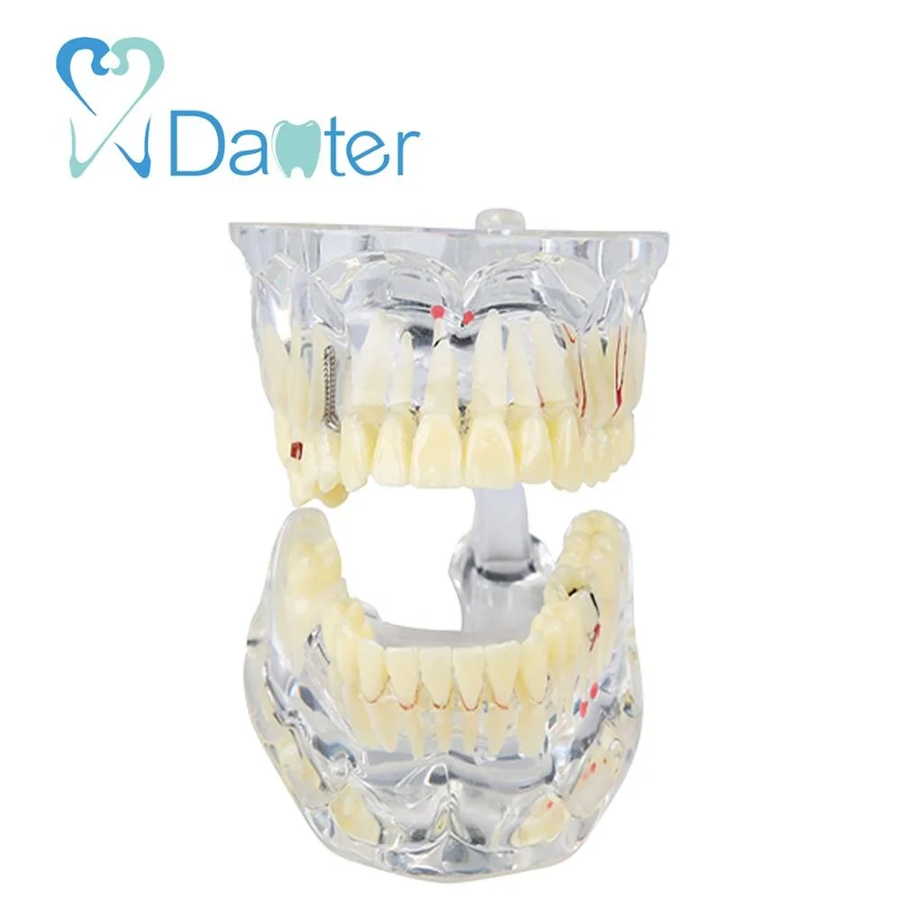 Adult Dental Pathologies Teeth Model with Missing Teeth for showing caries apical cyst tartar implant impaction missing teeth