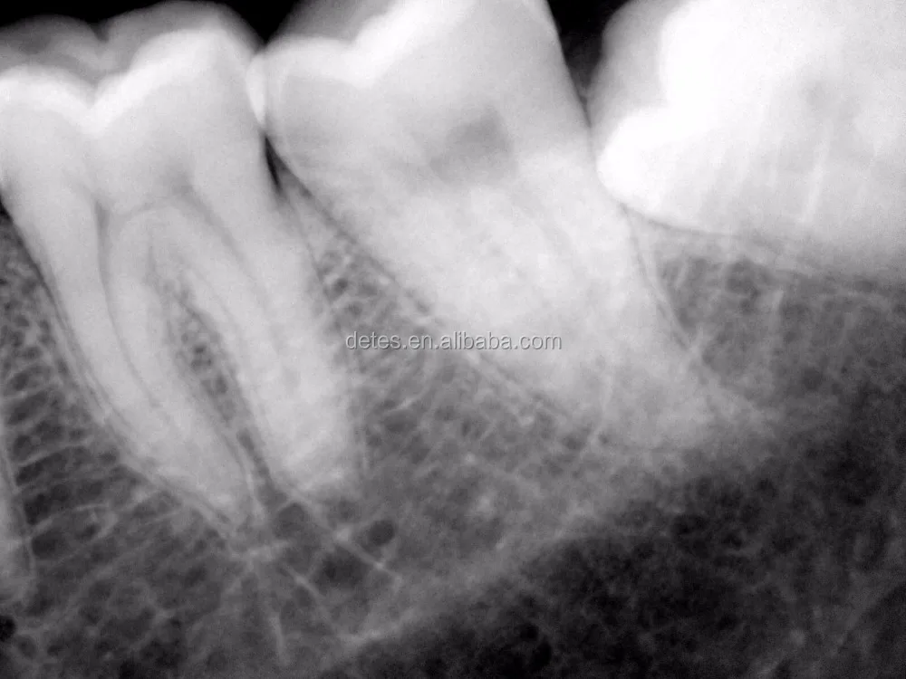 HOT SALE cheap HDR dental digital x-ray sensor,x ray sensor dental digital