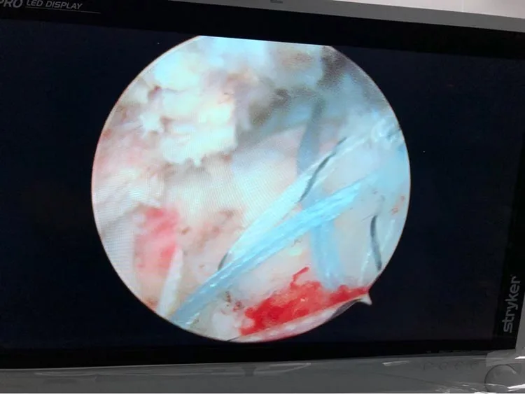 Surgical Arthroscope 2.7mm 4mm 30 degrees arthroscopy trocar arthroscopy instruments