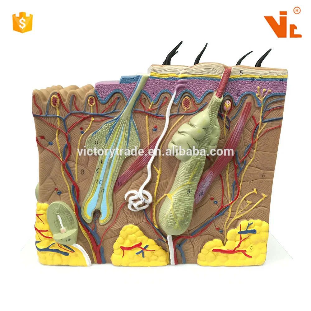 V-AM030 enlarged human psoriasis anatomical model design for teaching use