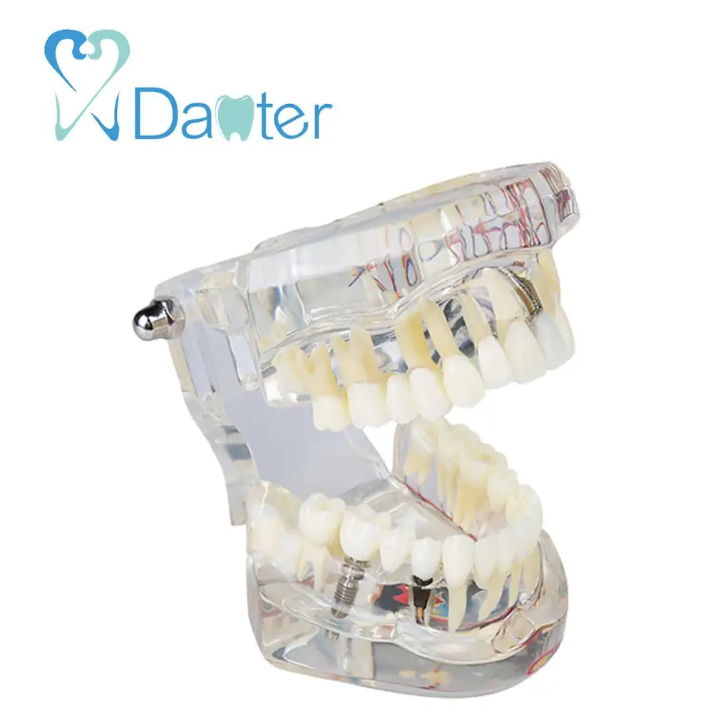 A200-2 All in one Dental Implant Model with Nerve and Removable Teeth crown bridges