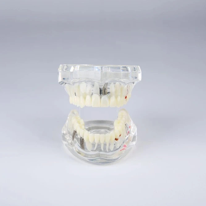 Implant restoration pathological dental model for demonstration