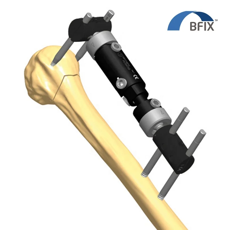 
Bfix Orthopedic Micro Movement Limb Reconstruction External Fixator System 