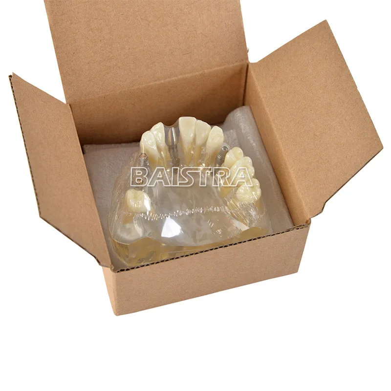 Широко используются пластиковые 4 гвоздя импланты модель зубов Модель