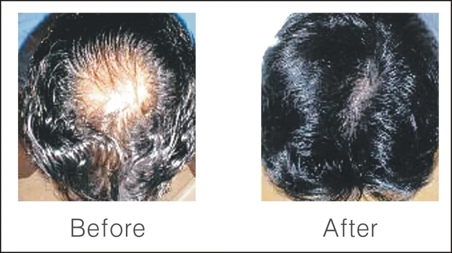 
Otesaly Anti-Hair Loss For Mesotherapy Solution,Moisture,Nourishes,And Improves The Hair And Scalp Condition 
