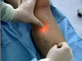 Endovenous Laser Ablation