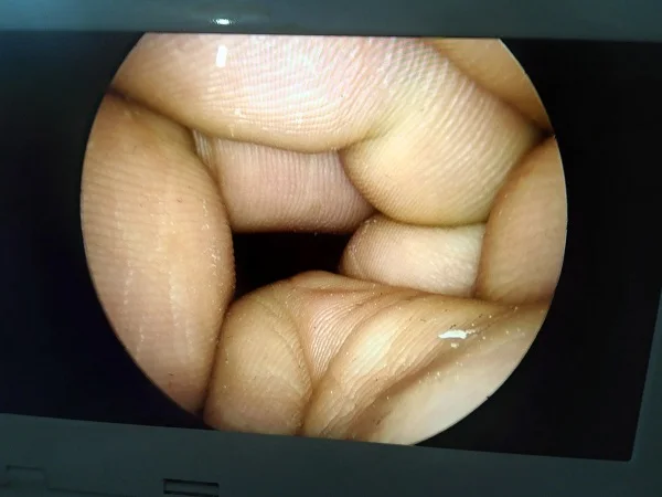 Medical China best rigid nasal endoscope price