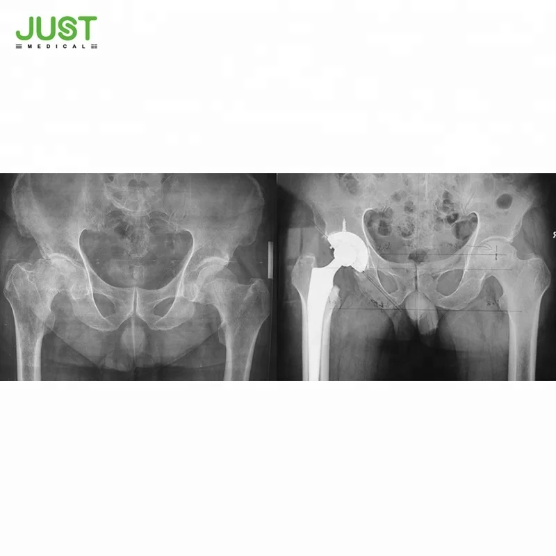 
Titanium femoral stem Hip Joint Replacement Prosthesis 