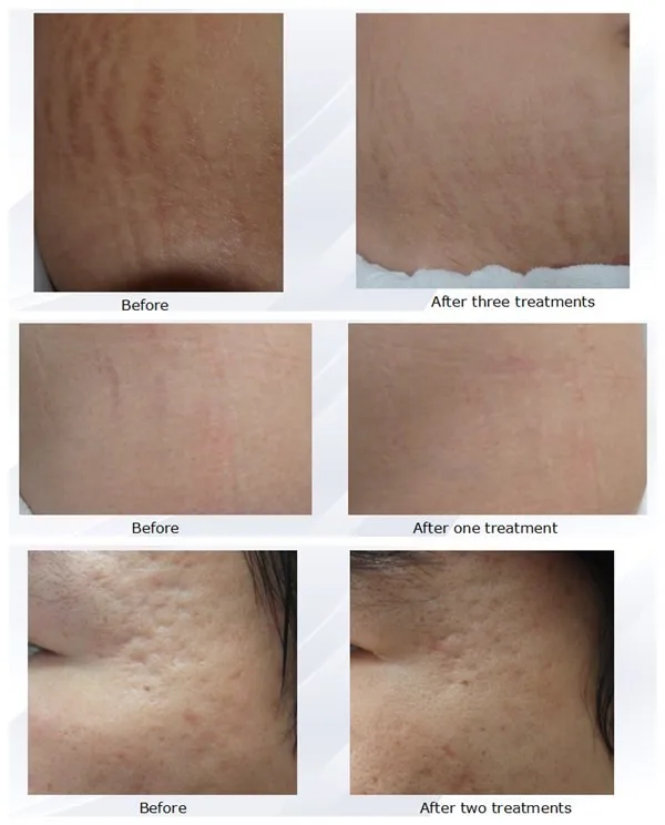 GSD 1550nm erbium glass optical fiber laser tatoo removal(GSD Renas)