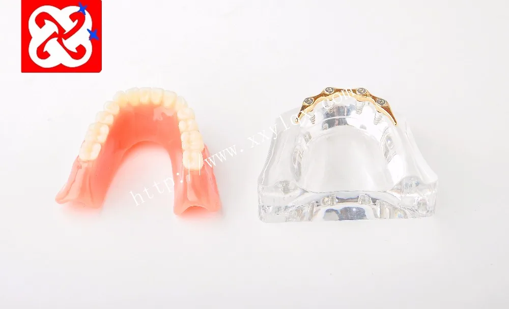 Overdenture implant model with silver/ golden bar
