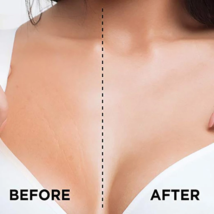 Amazon, Лидер продаж, антивозрастной силиконовый нагрудный комплект для женщин против морщин