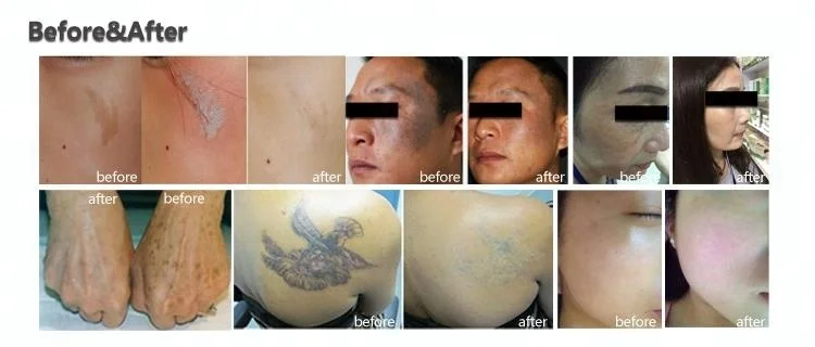 ADSS 2022 new Picosecond laser beauty machine/ picosecond laser to remove tatoo
