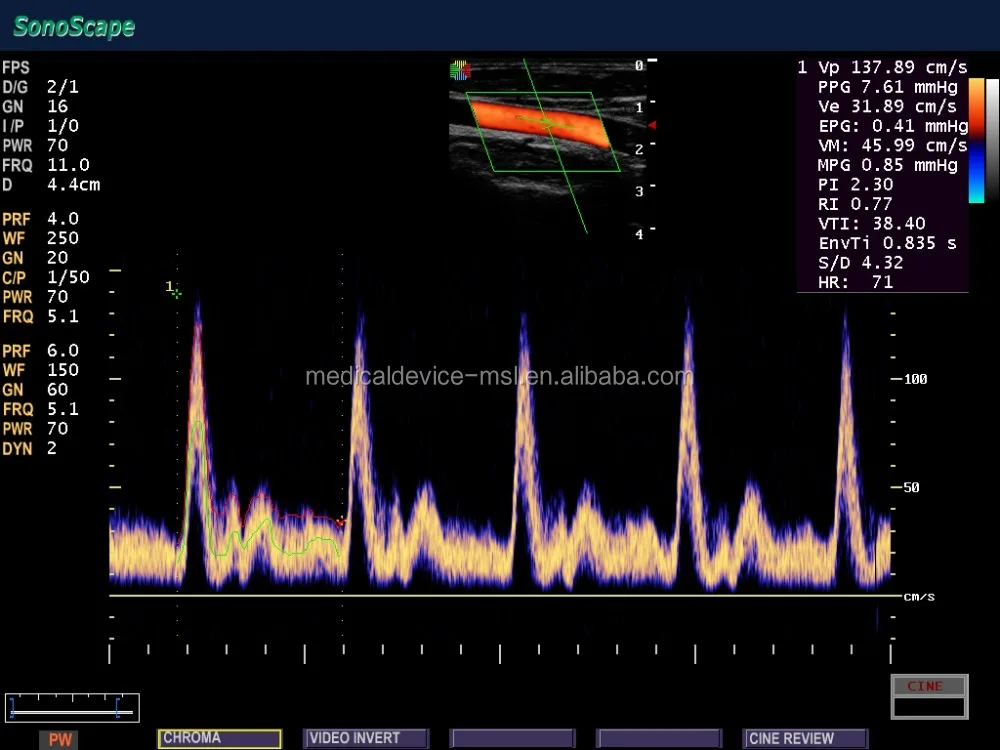 2019 Advanced Technology 4D Imaging sonoscape s8 portable ultrasound machine