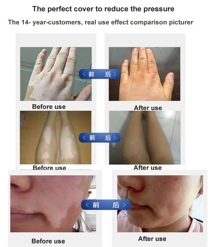 
customizing with private label professional natural plant waterproof vitiligo concealing pen &nbsp;