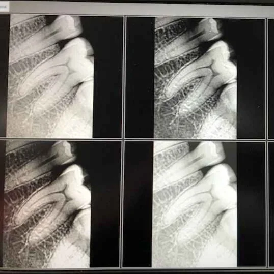 digital panoramic dental xray sensor for dental x ray sensor price