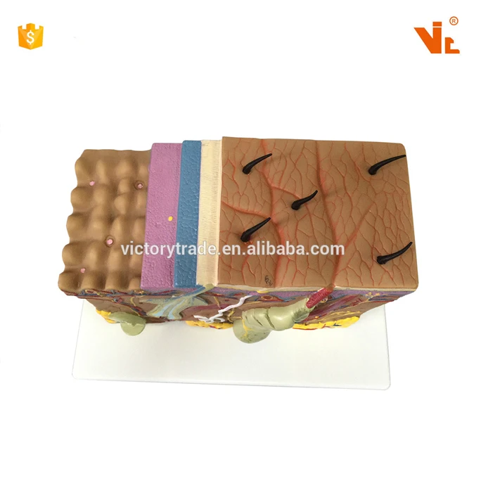 V-AM030 enlarged human psoriasis anatomical model design for teaching use