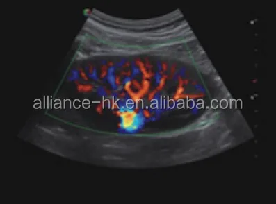 Sonoscape S22 Trolley 4D цветная допплеровская ультразвуковая система, 8 дюймов, сенсорный экран 18,5 дюйма, ЖК-дисплей