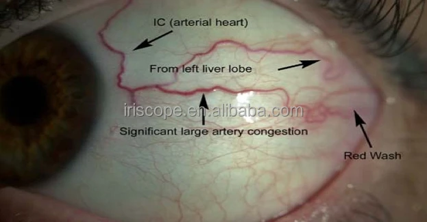 2016 latest 12.0 MP iriscope eye diagnostic cameras for therapists