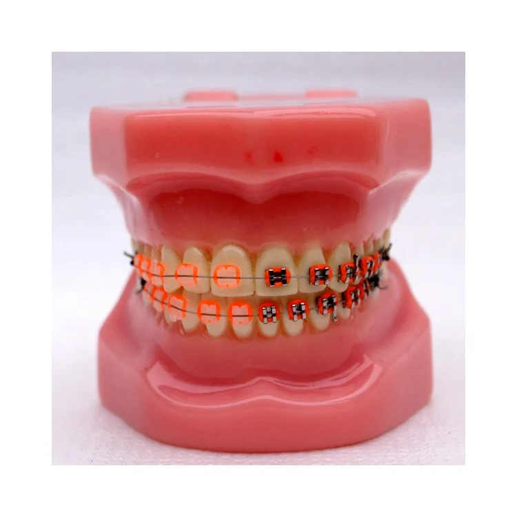 Dental Orthodontic model With metal brackets