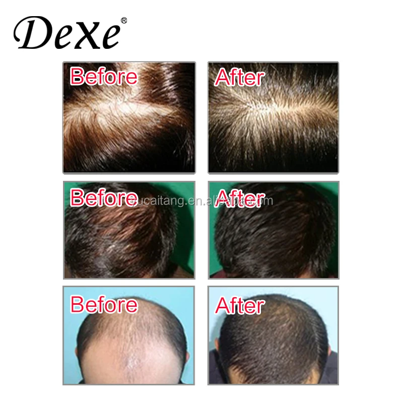 2020 hot sale hair regrow product Chinese Herb dexe Anti Hair Loss shampoo