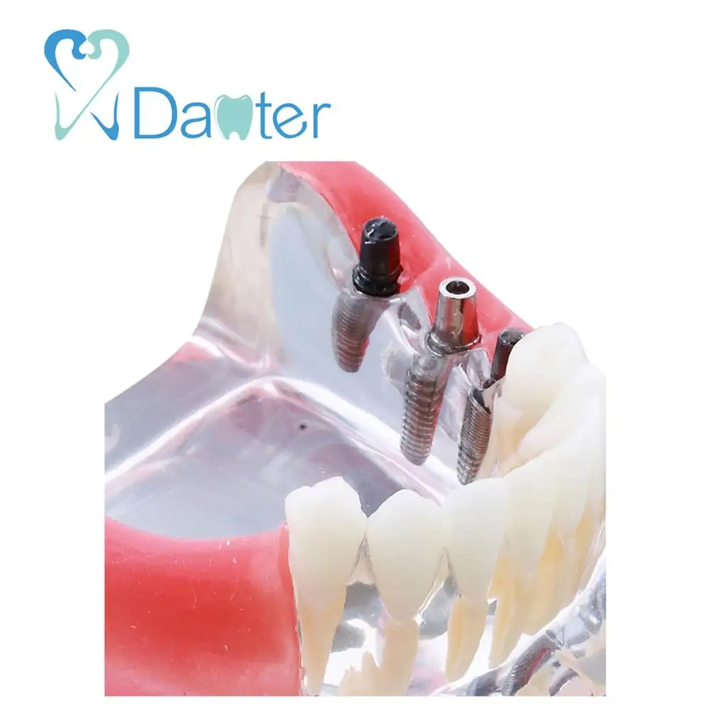 New Design Dental Implant Model with Restoration Dental Teaching Model