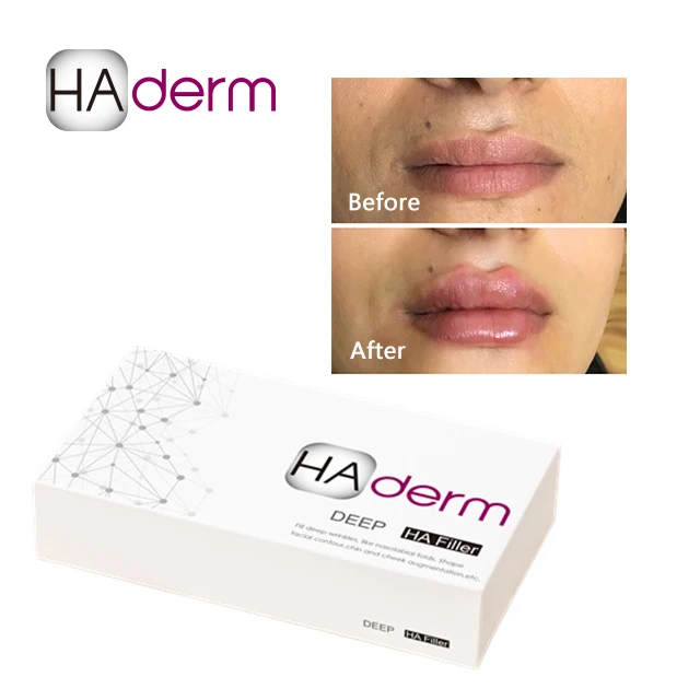 
Reyoungel Hyaluronate Acid Dermal Filler Lip Enhancement Injection 
