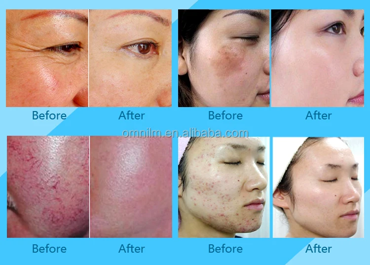 Professional Facial Care Arc-shaped Portable LED Light Beauty Equipment for Facial Care Skin Problems Solving Home Use