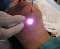 laser liposuction surgery mini-invasive laser surgery melting fat slimming lipolysis laser