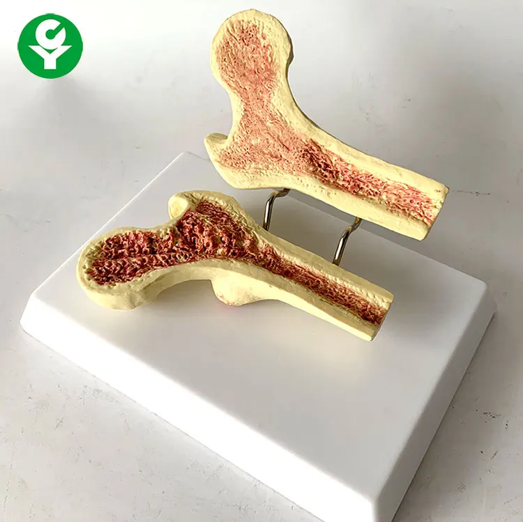 Модель человеческого остеопороза, модель бедренной кости, модель человеческого скелета