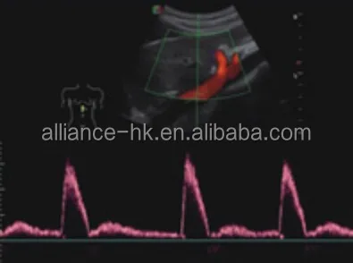 Sonoscape S22 Trolley 4D цветная допплеровская ультразвуковая система, 8 дюймов, сенсорный экран 18,5 дюйма, ЖК-дисплей