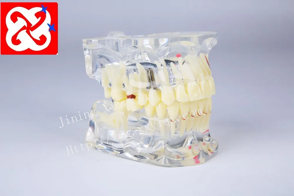 Adult pathological dental model with missing tooth caries apical cyst, tartar ,implant etc