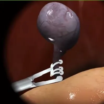 WEIDE None-absorbable surgical hemolok clips polymer clips for laparoscopic Cholecystectomy