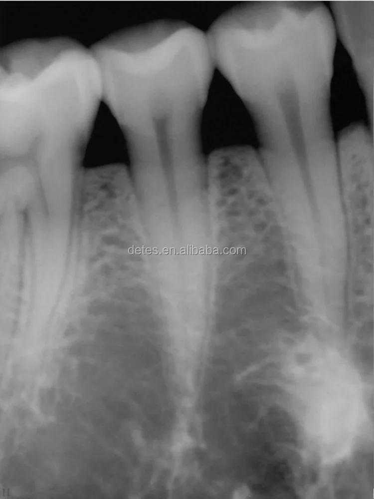 HOT SALE cheap HDR dental digital x-ray sensor,x ray sensor dental digital