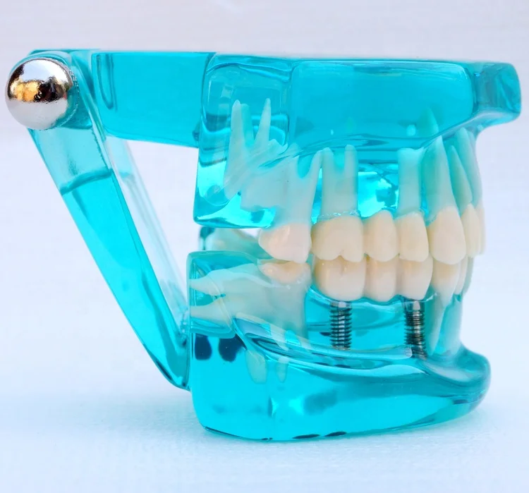 Tooth Restoration model with Implant