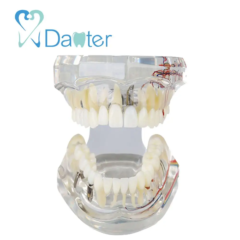 A200-2 All in one Dental Implant Model with Nerve and Removable Teeth crown bridges