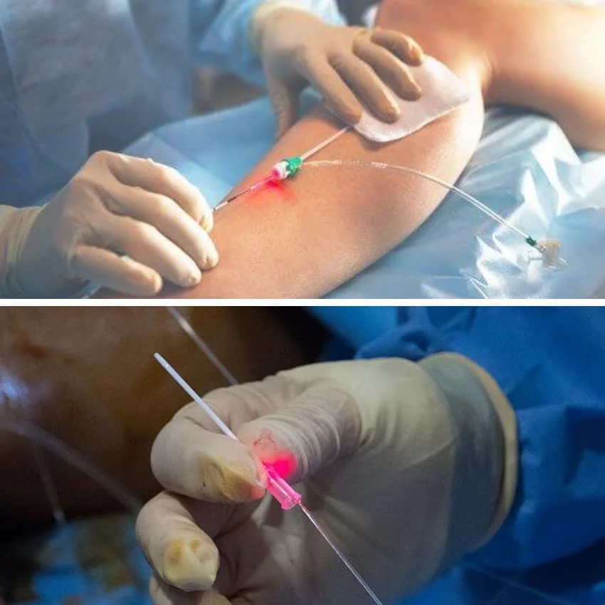 Endolaser diode 980 nm 1470 vaser liposucion 1470nm diode laser single wavelength face lifting endoskin laser